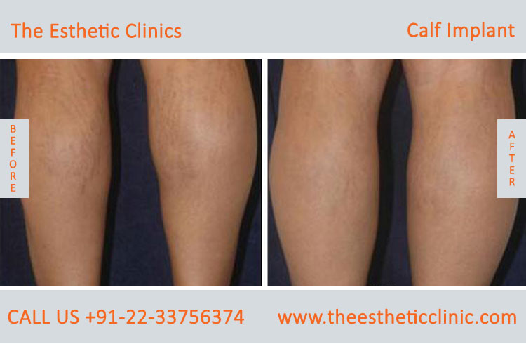 Calf implants, Calf Augmentation surgery before after photos in mumbai india (6)